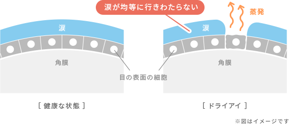 ドライアイの目の表面の状態