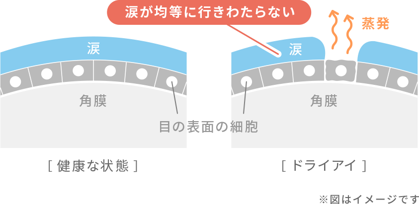 ドライアイの目の表面の状態